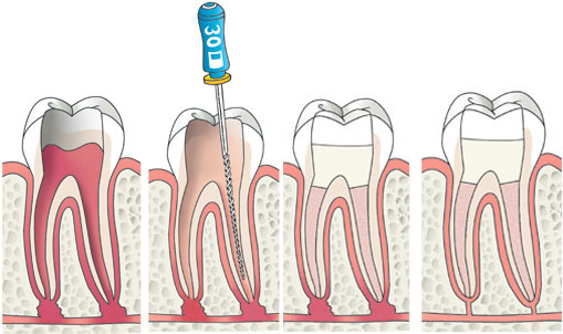 behandeling wortelkanaalbehandeling
